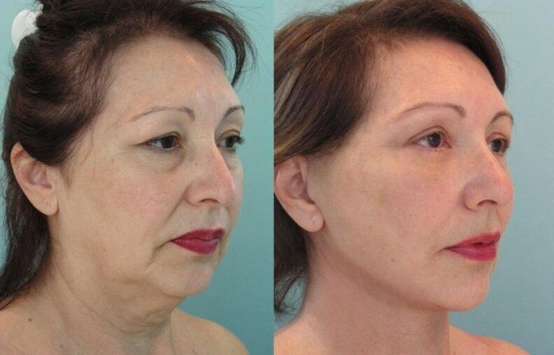 O resultado do rejuvenescimento da pele facial apertando com fios