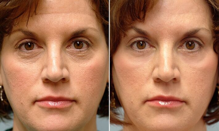 rosto antes e depois do rejuvenescimento fracionado a laser